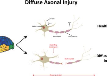 Difuzinis aksonų pažeidimas