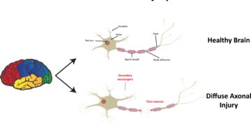 Difuzinis aksonų pažeidimas