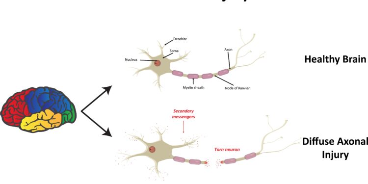 Difuzinis aksonų pažeidimas