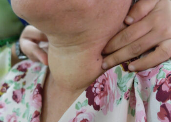 29 dalykai, kuriuos supras tik sergantys hipotiroze