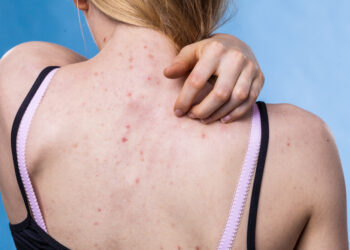 Kaip suvaldyti niežtinčius spuogus