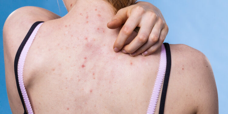 Kaip suvaldyti niežtinčius spuogus