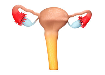 Gimdos sienelės (vidinis) mioma