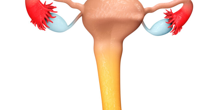 Gimdos sienelės (vidinis) mioma