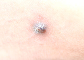 Ar turėčiau nerimauti dėl juodos šašos?