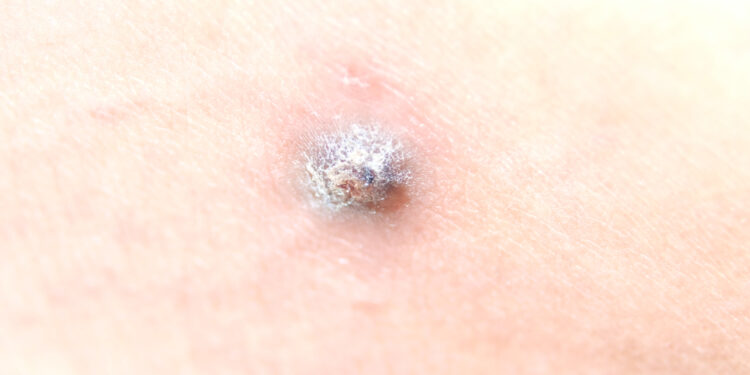 Ar turėčiau nerimauti dėl juodos šašos?