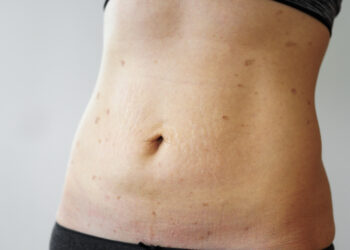 Ar lichen planus gali sukelti nuovargį?