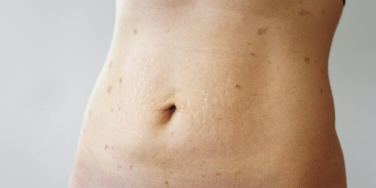 Ar lichen planus gali sukelti nuovargį?