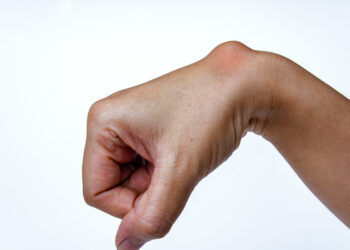 Ar galima išgydyti lipomą?