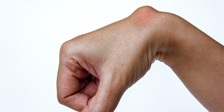 Ar galima išgydyti lipomą?