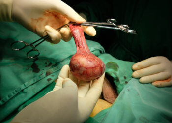 Ar teratomoje gali būti akių?