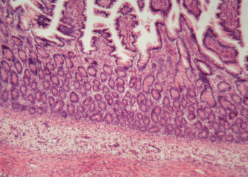 Ar galima išgydyti mikroskopinį kolitą, ar jis vėl atsinaujins?