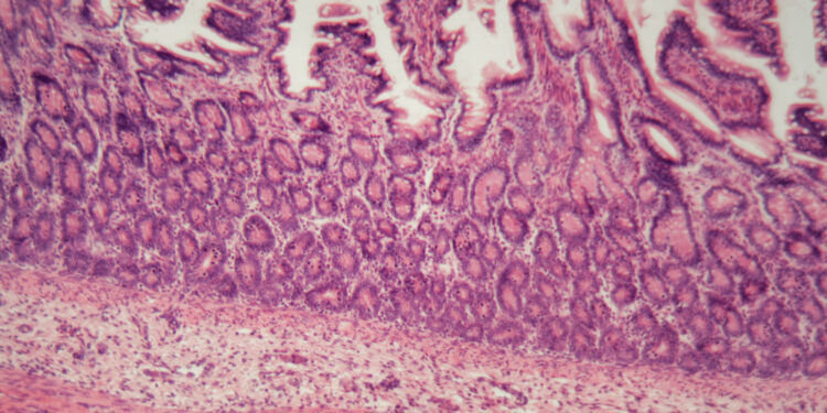 Ar galima išgydyti mikroskopinį kolitą, ar jis vėl atsinaujins?