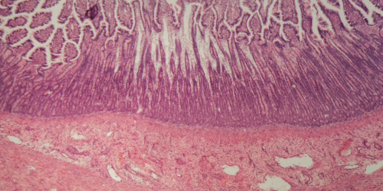 Ar mikroskopinį kolitą sukelia imuninės sistemos reakcija?