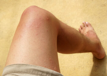 Kiek laiko trunka dilgėlinė?