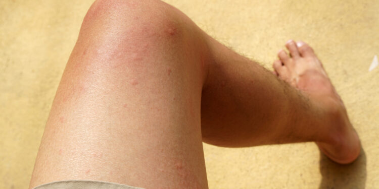 Kiek laiko trunka dilgėlinė?