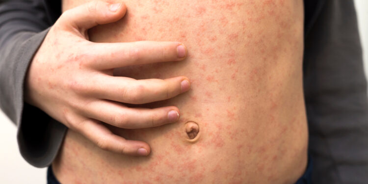 Ar pityriazės rožės bėrimas ant pilvo sukelia niežulį?