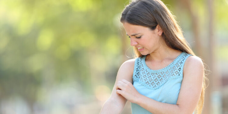 Patarimai, kaip valdyti psoriazę karštu oru