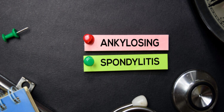 Ankilozinio spondilito progresavimas