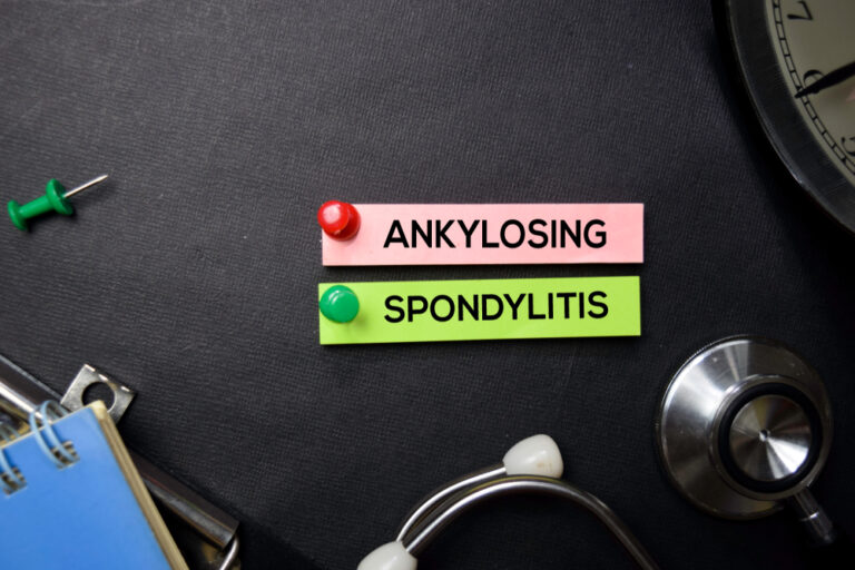 Ankilozinio spondilito progresavimas