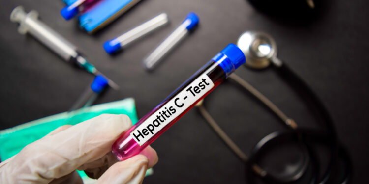 Ar galima užsikrėsti hepatitu C per seiles?