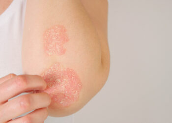 Ar eritroderminė žvynelinė turi įtakos gyvenimo trukmei?