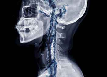 Stuburo ir bazilinių arterijų nepakankamumas: simptomai ir gydymas