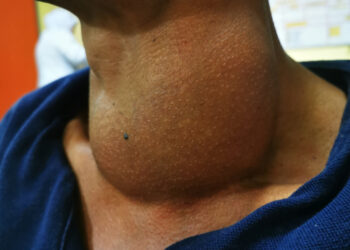 Medulinė skydliaukės vėžys: prognozė, gyvenimo trukmė ir išgyvenamumas