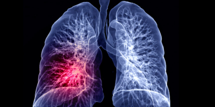 Kiek laiko galima išgyventi su plaučių embolija?