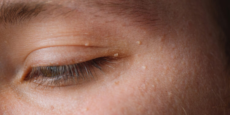 Karpos: atpažinimas, priežastys, rūšys, gydymas ir profilaktika