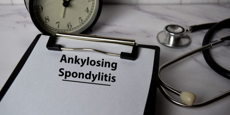 Atsakymų paieškos sergant ankiloziniu spondilitu: Johannos istorija