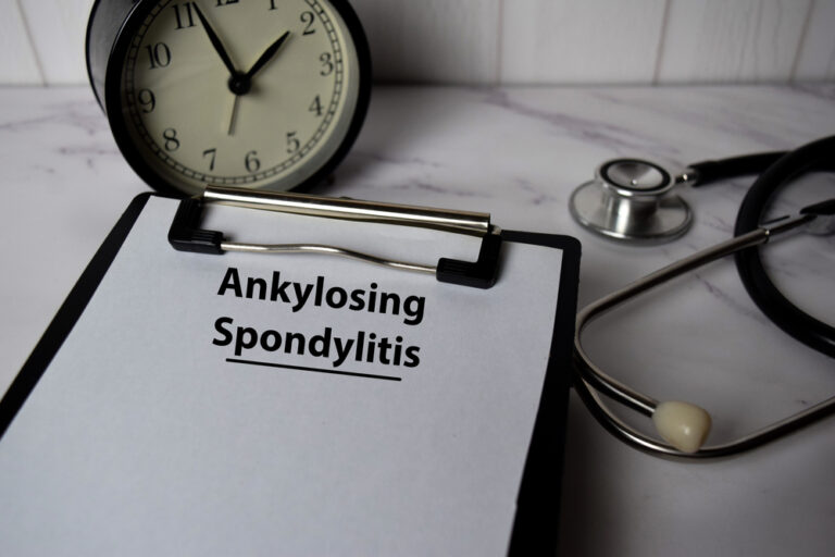 Atsakymų paieškos sergant ankiloziniu spondilitu: Johannos istorija