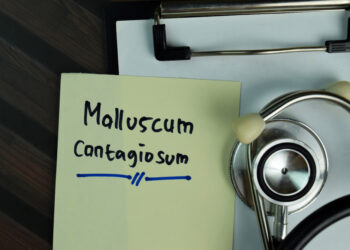 Kaip naudoti moliuskiną pūslių gydymui