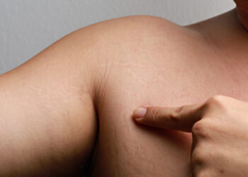 Ar normalu turėti strijas ant pečių?