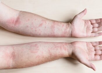 Egzema: svarbiausi faktai ir statistika