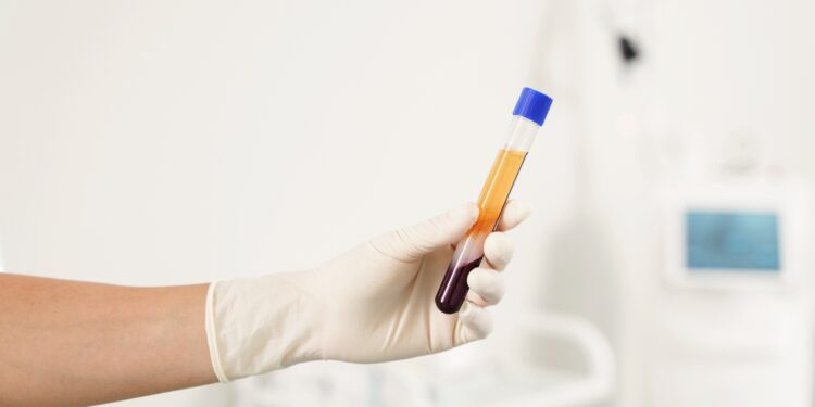 Kaip paruošiama trombocitais praturtinta plazma?