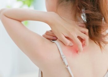 Niežtintis sprandas