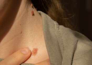 Kaip greitai plinta melanoma?