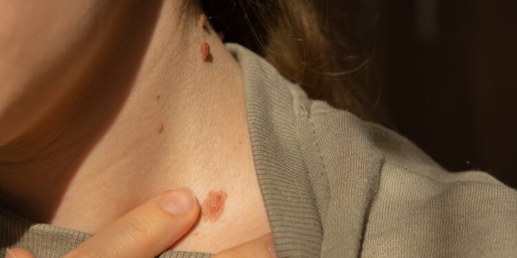 Kaip greitai plinta melanoma?