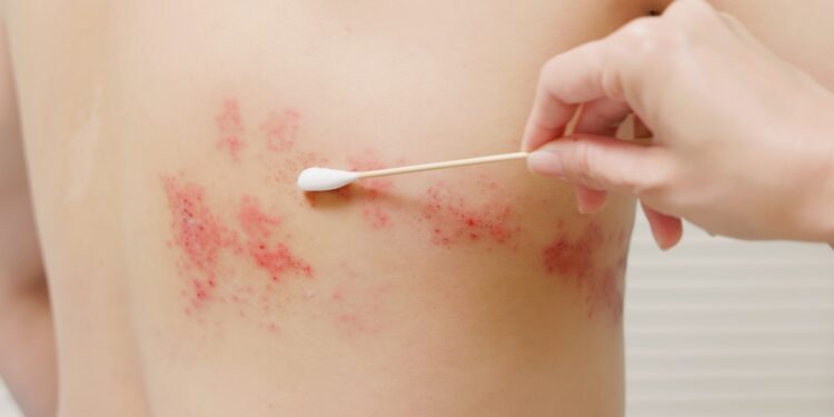 Herpeso inkubacinis laikotarpis