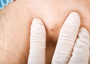 Bartholin liaukos cistos gydymas namuose