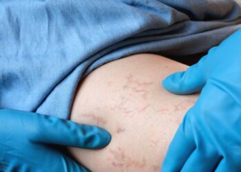 Kiek kainuoja kapiliarų (arba kraujagyslių) šalinimas?