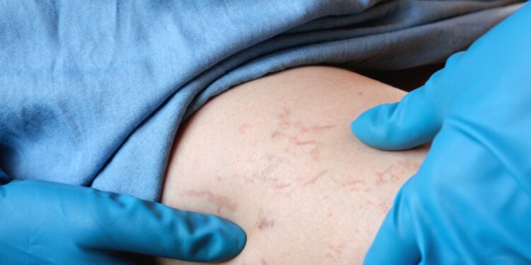 Kiek kainuoja kapiliarų (arba kraujagyslių) šalinimas?