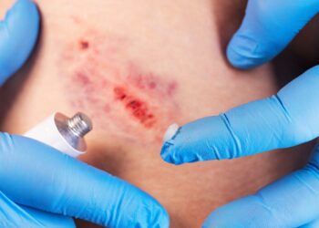 Ar sumušimai po riešo kanalo operacijos yra įprasti?