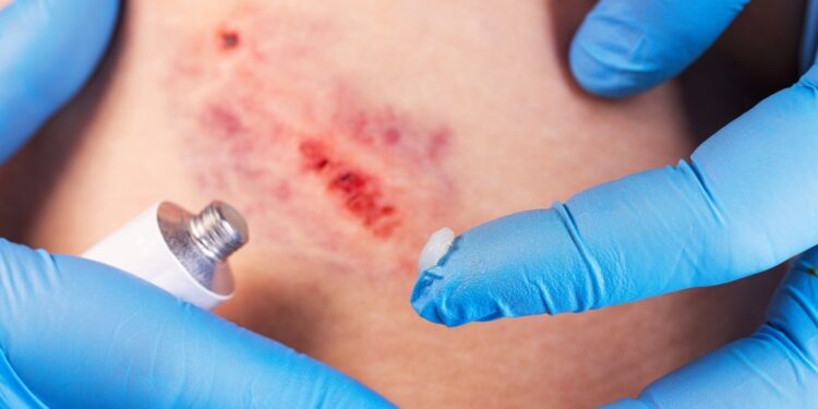 Ar sumušimai po riešo kanalo operacijos yra įprasti?