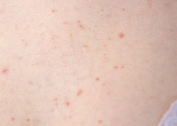 Spuogai ant krūtų: ką daryti?