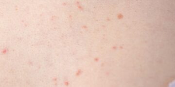 Spuogai ant krūtų: ką daryti?