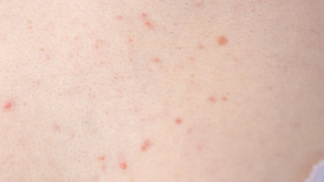 Spuogai ant krūtų: ką daryti?