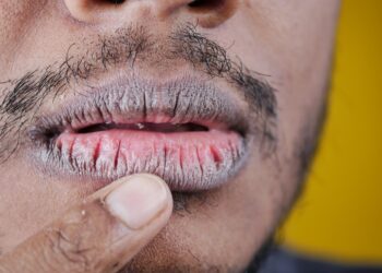 Kaip atsikratyti suskeldėjusių lūpų