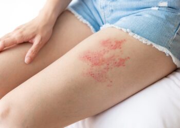 Juostinės pūslelinės gydymas vaistu Valtrex